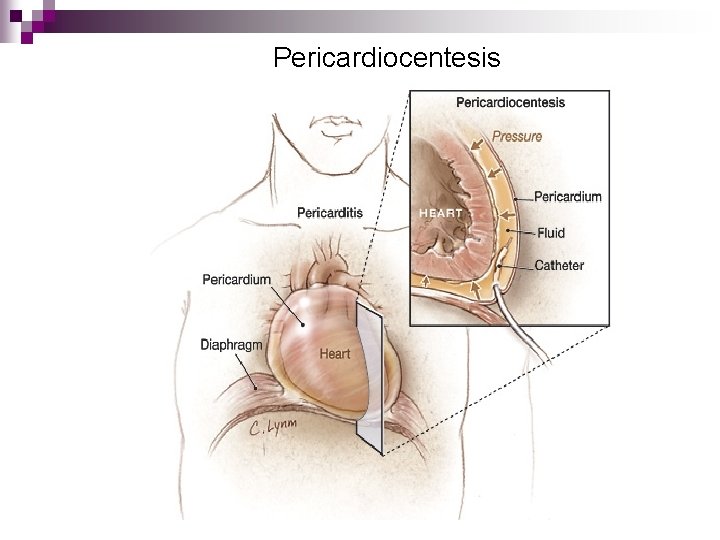 Pericardiocentesis 