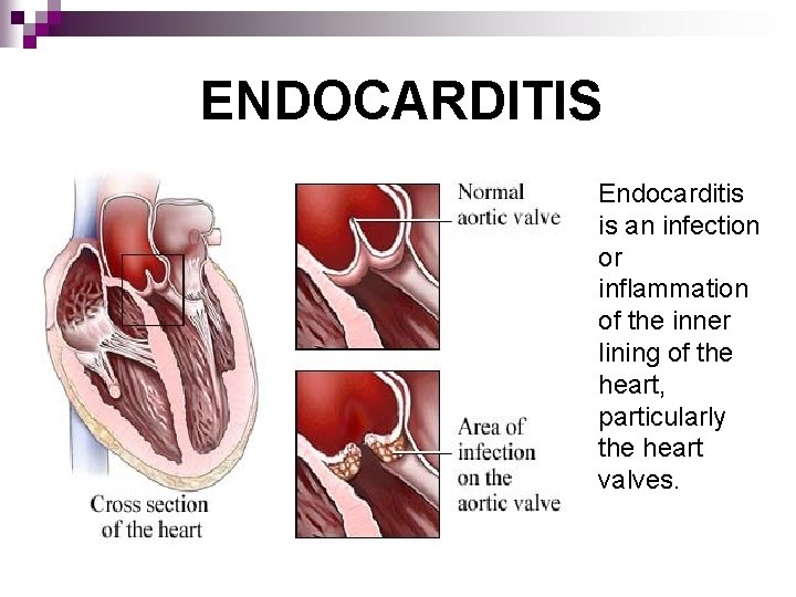 ENDOCARDITIS Endocarditis is an infection or inflammation of the inner lining of the heart,