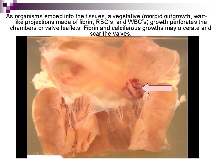 As organisms embed into the tissues, a vegetative (morbid outgrowth, wartlike projections made of