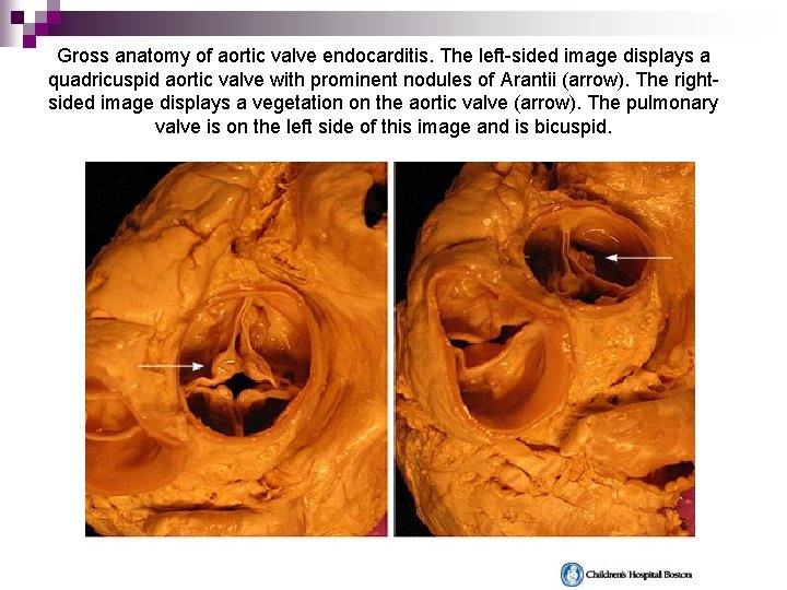Gross anatomy of aortic valve endocarditis. The left-sided image displays a quadricuspid aortic valve