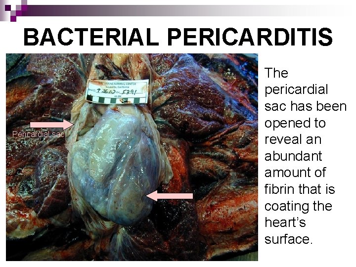 BACTERIAL PERICARDITIS Pericardial sac The pericardial sac has been opened to reveal an abundant