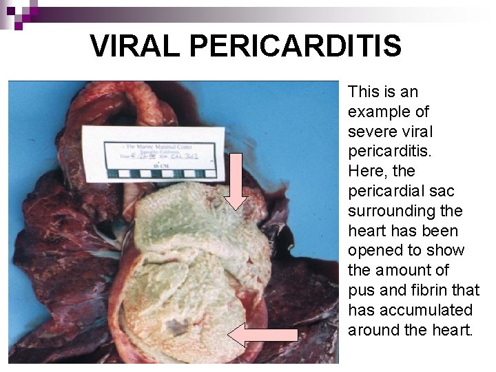 VIRAL PERICARDITIS This is an example of severe viral pericarditis. Here, the pericardial sac