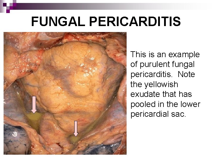 FUNGAL PERICARDITIS This is an example of purulent fungal pericarditis. Note the yellowish exudate