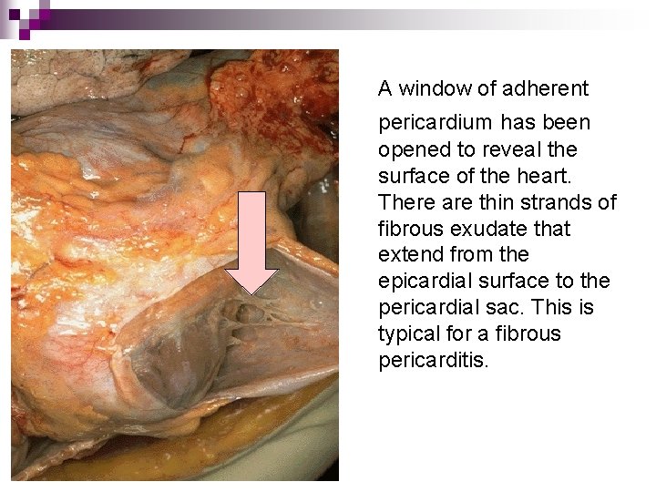 A window of adherent pericardium has been opened to reveal the surface of the