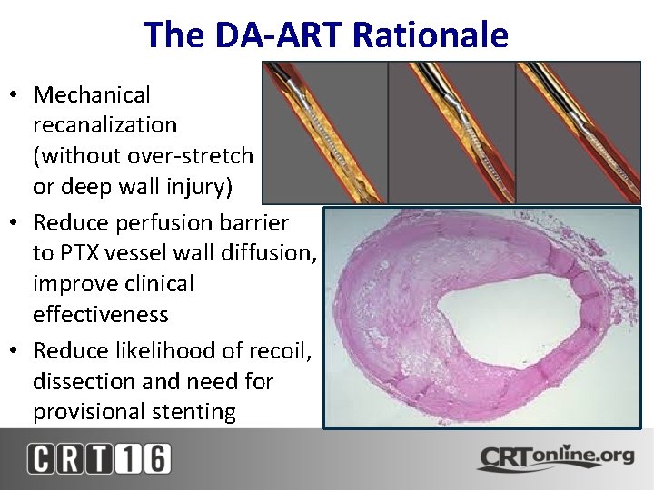 The DA-ART Rationale • Mechanical recanalization (without over-stretch or deep wall injury) • Reduce