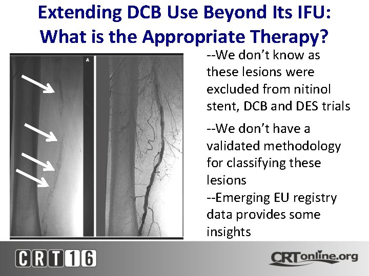 Extending DCB Use Beyond Its IFU: What is the Appropriate Therapy? • --We don’t