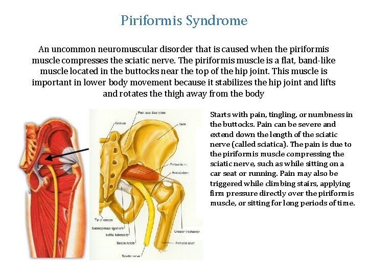 Piriformis Syndrome An uncommon neuromuscular disorder that is caused when the piriformis muscle compresses