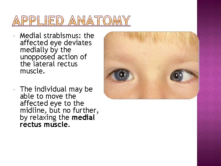  Medial strabismus: the affected eye deviates medially by the unopposed action of the
