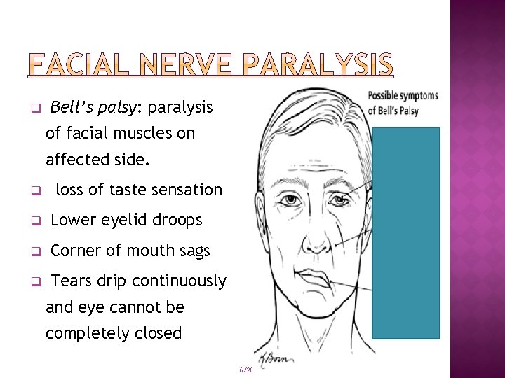 q Bell’s palsy: paralysis of facial muscles on affected side. q loss of taste