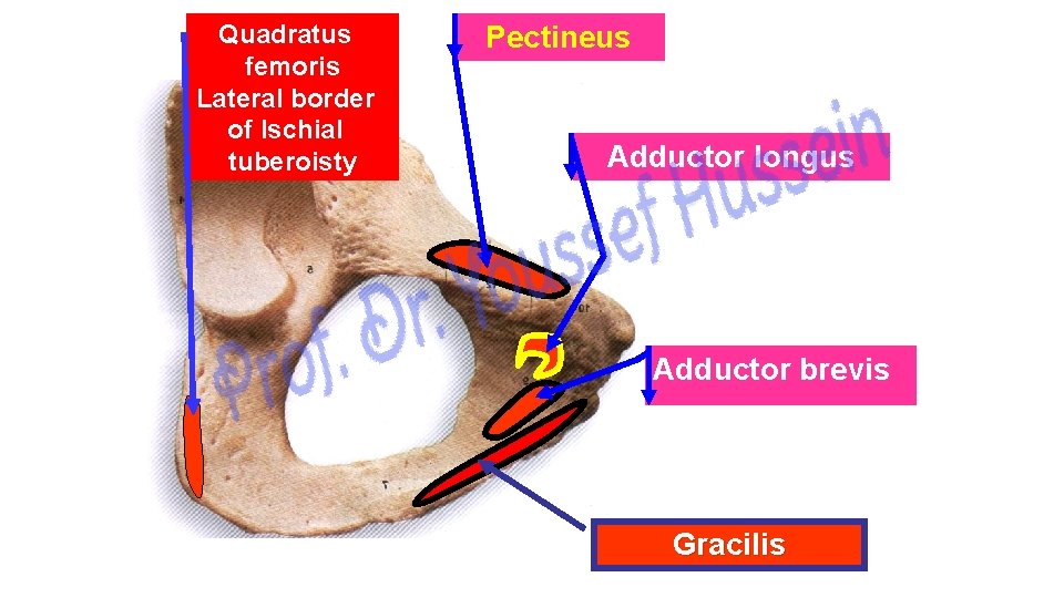 Quadratus femoris Lateral border of Ischial tuberoisty Pectineus Adductor longus Adductor brevis Gracilis 