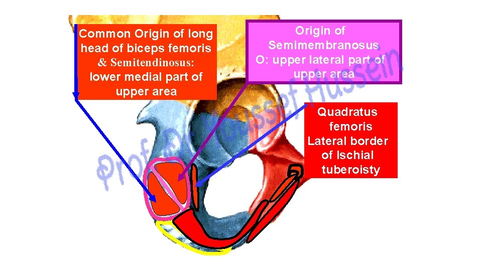 Common Origin of long head of biceps femoris & Semitendinosus: lower medial part of