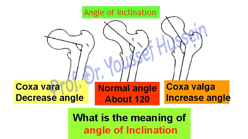 Angle of Inclination Coxa vara Decrease angle Normal angle About 120 Coxa valga Increase