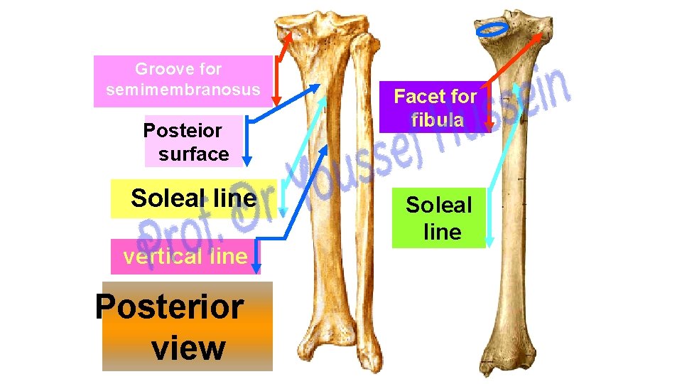 Groove for semimembranosus Posteior surface Soleal line vertical line Posterior view Facet for fibula