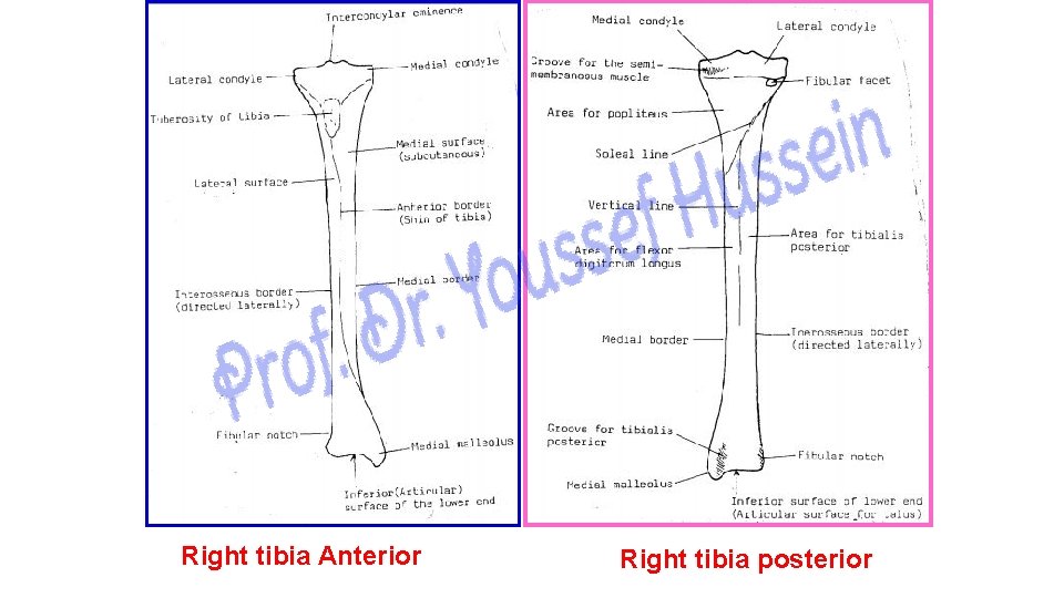 Right tibia Anterior Right tibia posterior 