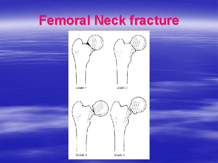 Femoral Neck fracture 