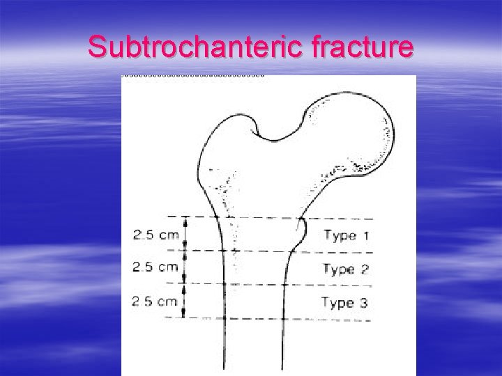 Subtrochanteric fracture 