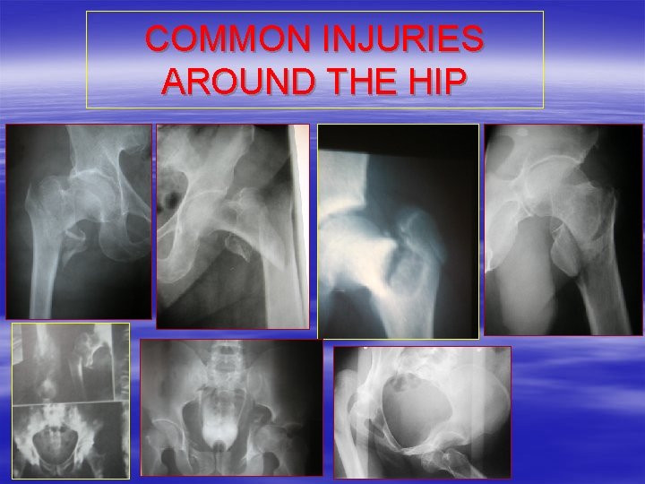 COMMON INJURIES AROUND THE HIP 