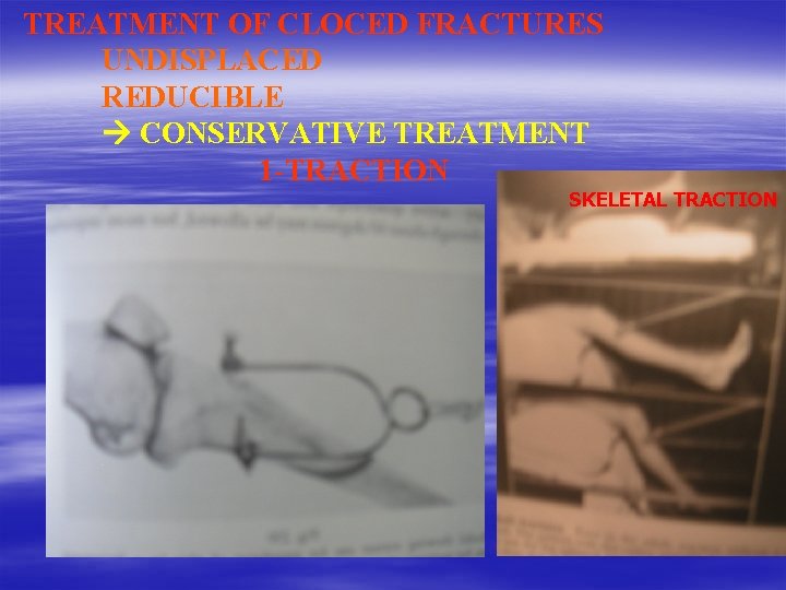 TREATMENT OF CLOCED FRACTURES UNDISPLACED REDUCIBLE CONSERVATIVE TREATMENT 1 -TRACTION SKELETAL TRACTION 