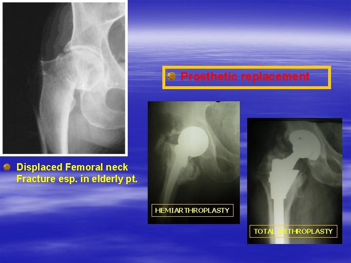 Prosthetic replacement Displaced Femoral neck Fracture esp. in elderly pt. HEMIARTHROPLASTY TOTAL ARTHROPLASTY 