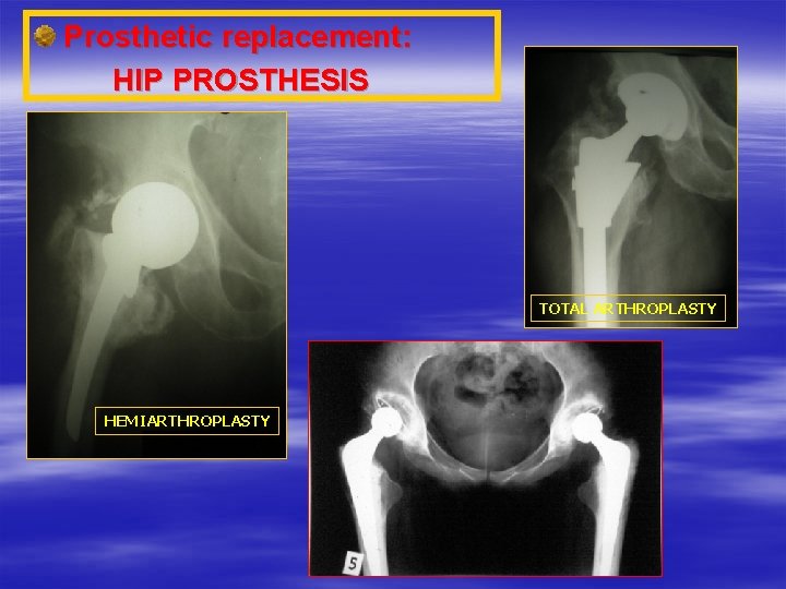 Prosthetic replacement: HIP PROSTHESIS TOTAL ARTHROPLASTY HEMIARTHROPLASTY 