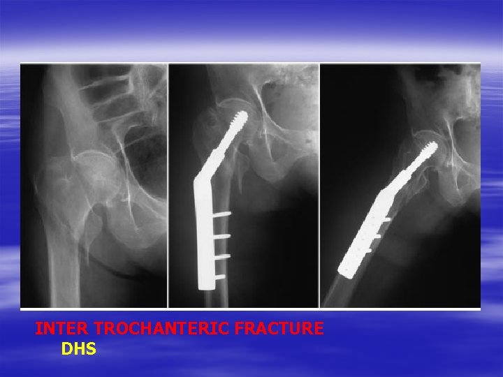 INTER TROCHANTERIC FRACTURE DHS 