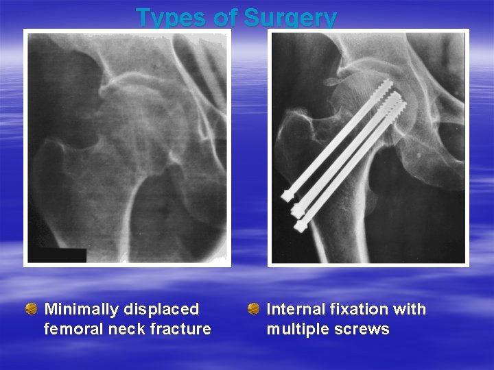 Types of Surgery Minimally displaced femoral neck fracture Internal fixation with multiple screws 