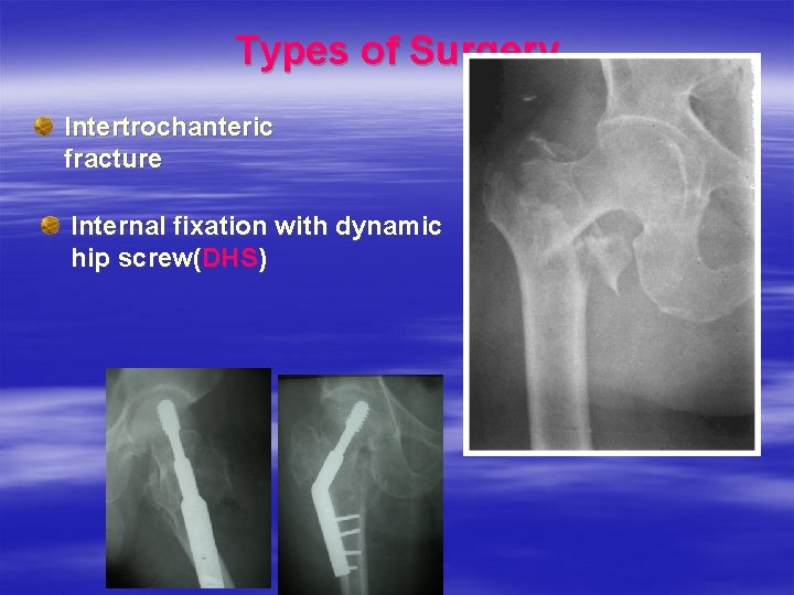 Types of Surgery Intertrochanteric fracture Internal fixation with dynamic hip screw(DHS) 