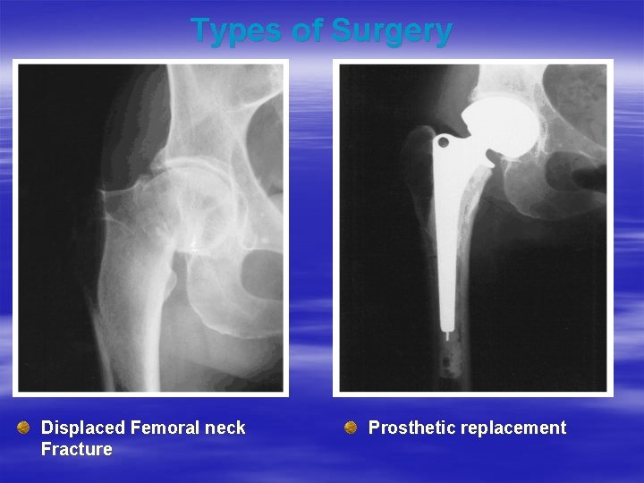 Types of Surgery Displaced Femoral neck Fracture Prosthetic replacement 