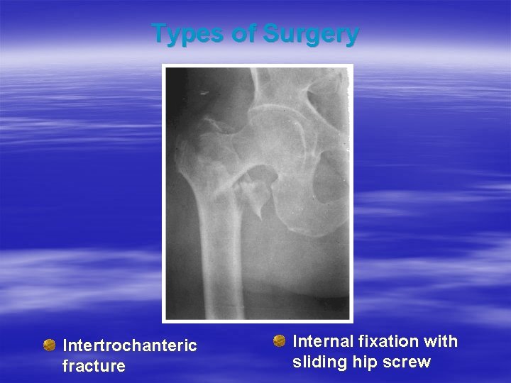 Types of Surgery Intertrochanteric fracture Internal fixation with sliding hip screw 
