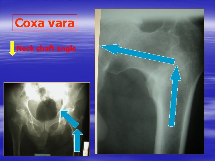 Coxa vara Neck shaft angle 