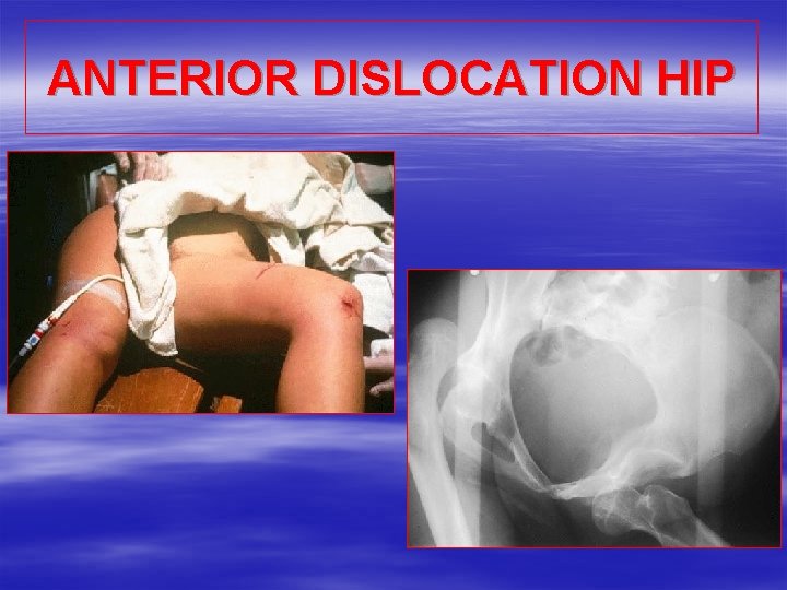 ANTERIOR DISLOCATION HIP 