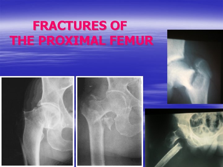 FRACTURES OF THE PROXIMAL FEMUR 