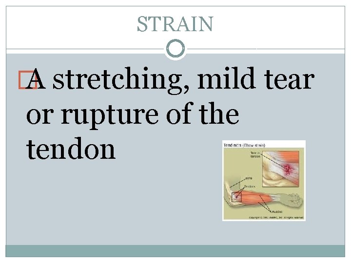 STRAIN � A stretching, mild tear or rupture of the tendon 