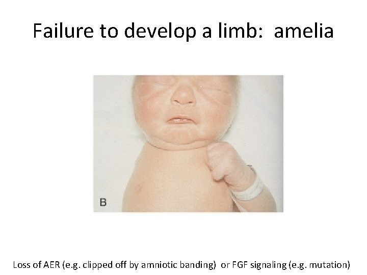 Failure to develop a limb: amelia Loss of AER (e. g. clipped off by