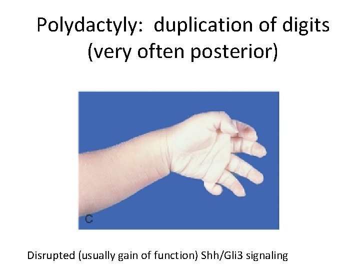 Polydactyly: duplication of digits (very often posterior) Disrupted (usually gain of function) Shh/Gli 3