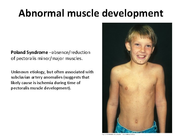Abnormal muscle development Poland Syndrome –absence/reduction of pectoralis minor/major muscles. Unknown etiology, but often
