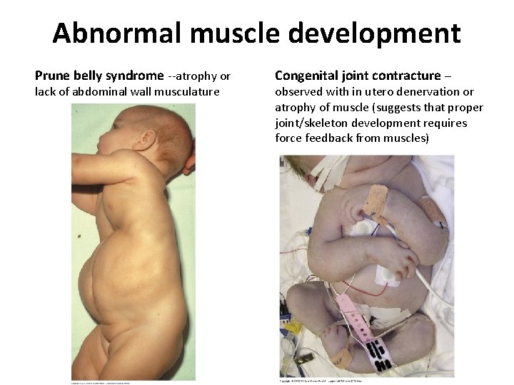 Abnormal muscle development Prune belly syndrome --atrophy or lack of abdominal wall musculature Congenital