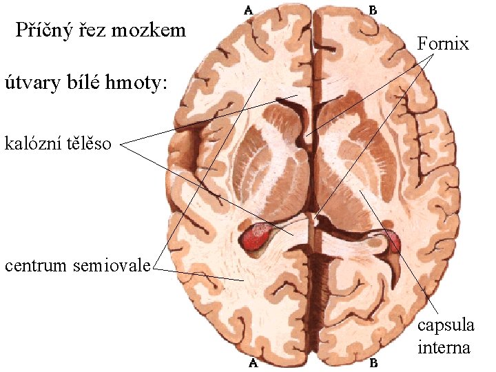 Příčný řez mozkem Fornix útvary bílé hmoty: kalózní tělěso centrum semiovale capsula interna 
