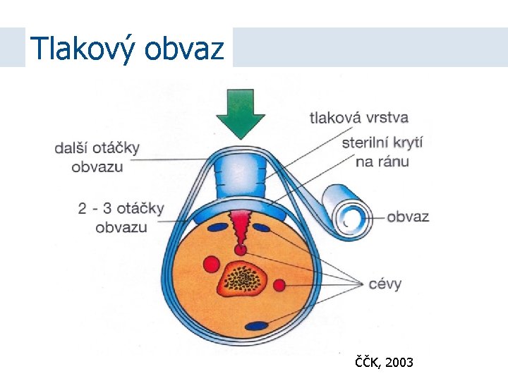 Tlakový obvaz ČČK, 2003 