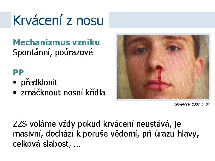 Krvácení z nosu Mechanizmus vzniku Spontánní, poúrazové PP předklonit zmáčknout nosní křídla Kelnarová, 2007.