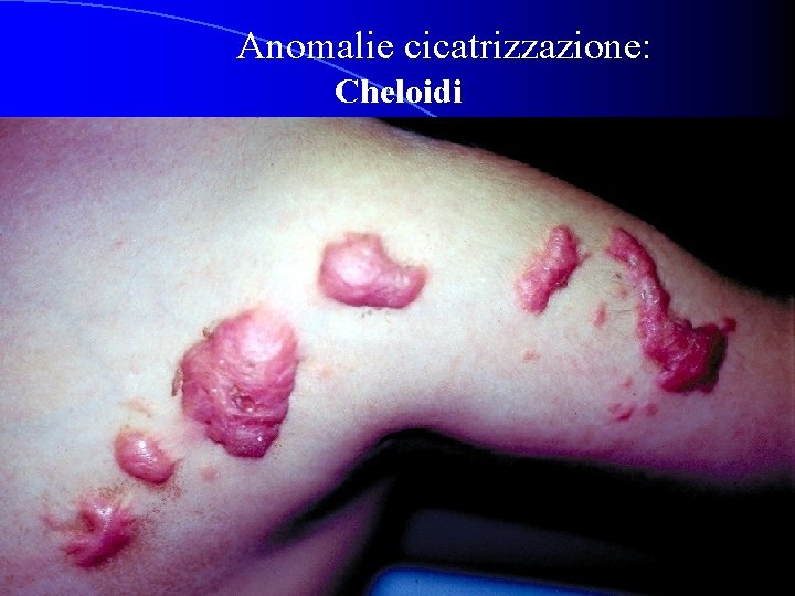 Anomalie cicatrizzazione: Cheloidi 