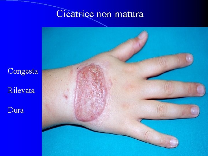 Cicatrice non matura Congesta Rilevata Dura 