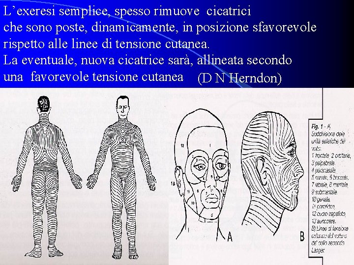 L’exeresi semplice, spesso rimuove cicatrici che sono poste, dinamicamente, in posizione sfavorevole rispetto alle