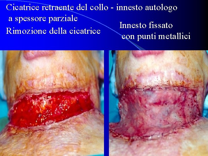 Cicatrice retraente del collo - innesto autologo a spessore parziale Innesto fissato Rimozione della