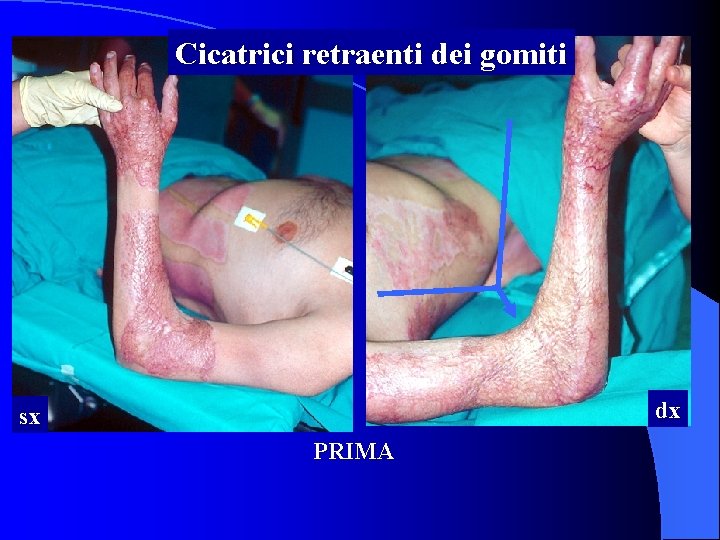 Cicatrici retraenti dei gomiti dx sx PRIMA 