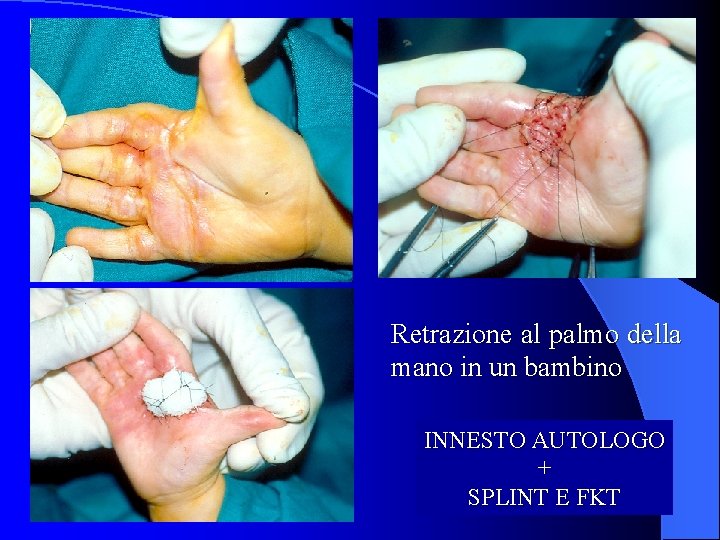 Retrazione al palmo della mano in un bambino INNESTO AUTOLOGO + SPLINT E FKT