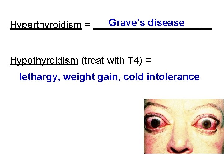 Hyperthyroidism = Grave’s_____ disease Hypothyroidism (treat with T 4) = lethargy, weight gain, cold