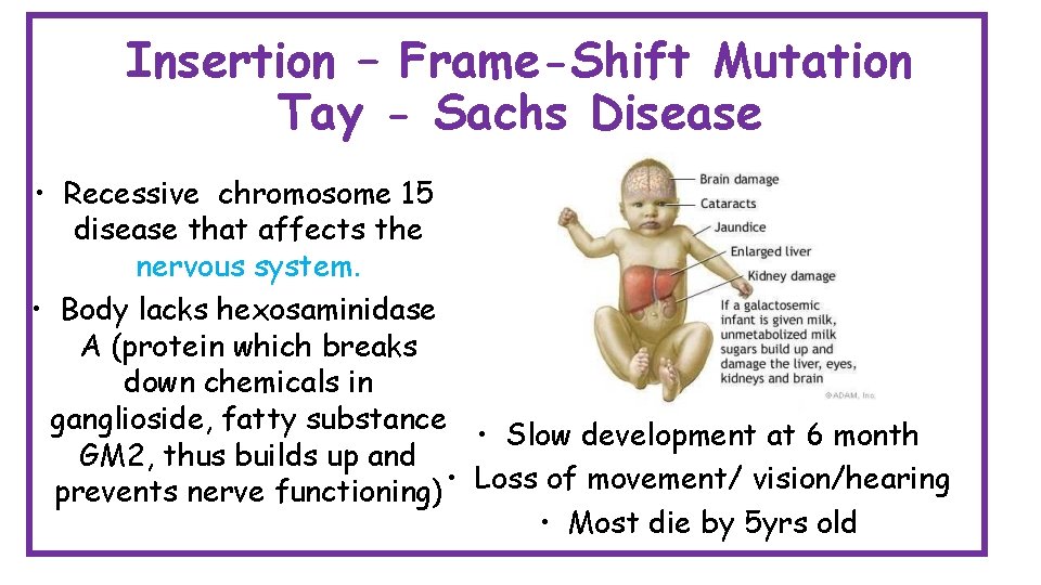 Insertion – Frame-Shift Mutation Tay - Sachs Disease • Recessive chromosome 15 disease that