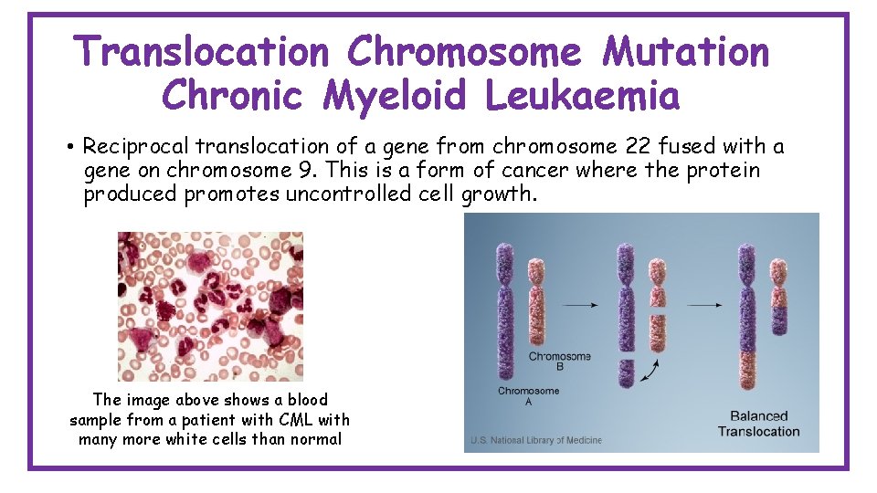 Translocation Chromosome Mutation Chronic Myeloid Leukaemia • Reciprocal translocation of a gene from chromosome