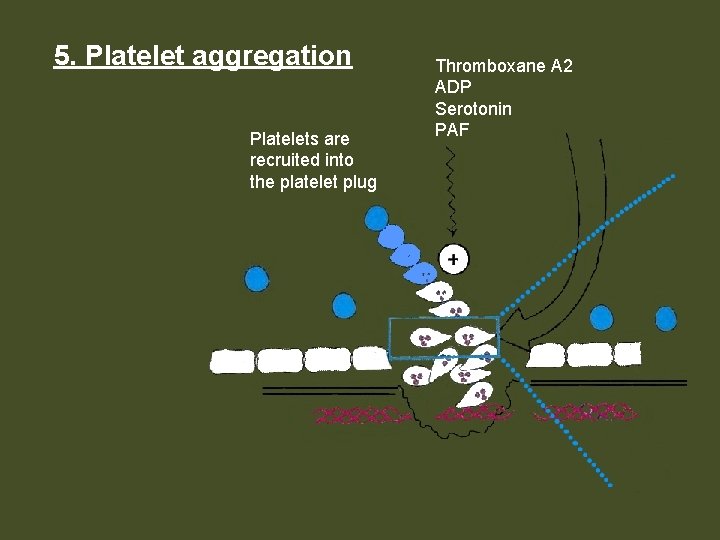 5. Platelet aggregation Platelets are recruited into the platelet plug Thromboxane A 2 ADP